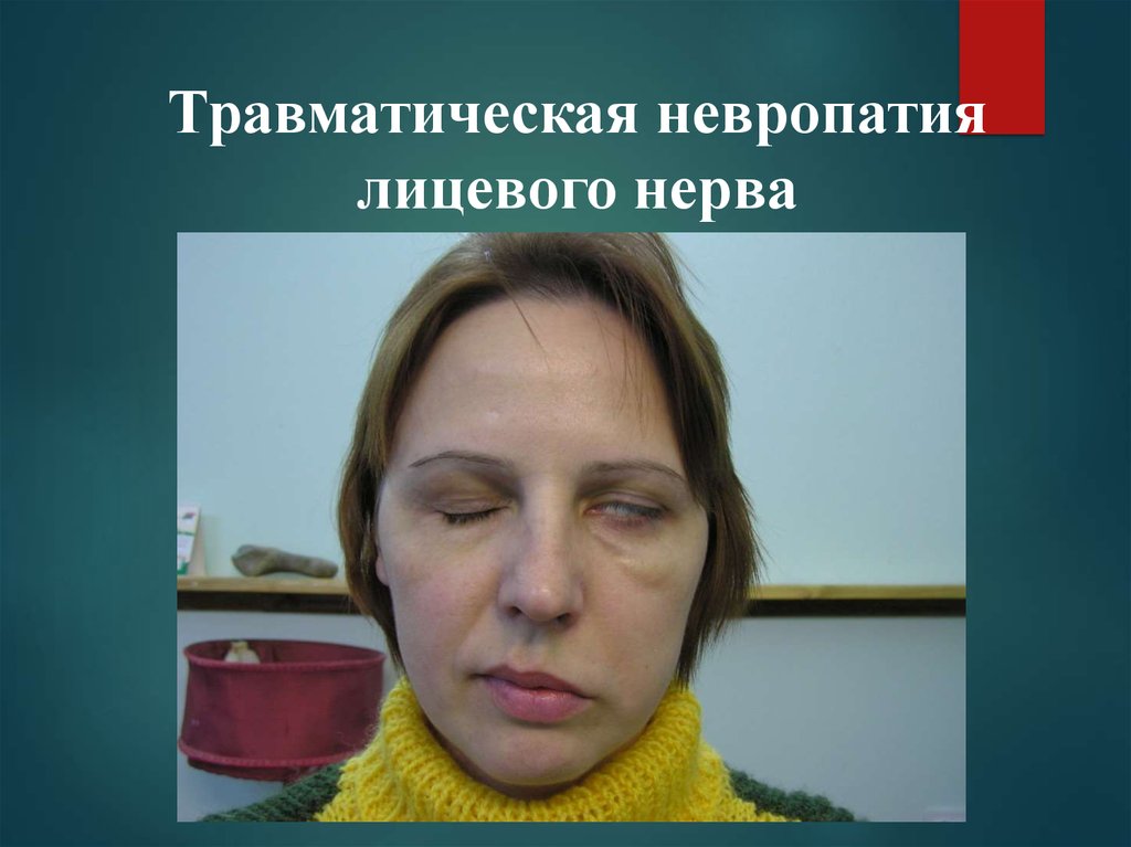 Паралич лицевого нерва фото до и после лечения