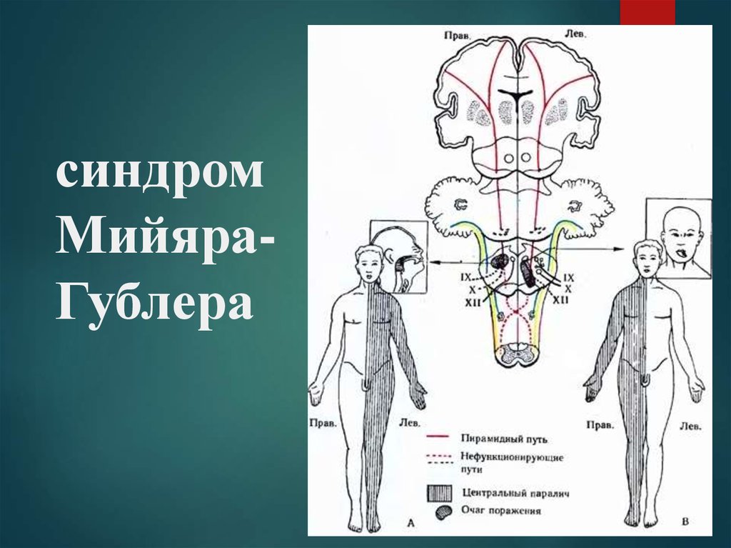 Синдром фовилля. Синдром Мийяра Гюблера. Синдром Мийя́ра—Гу́блера. Альтернирующий синдром Мийяра-Гублера. Синдром Мийяра Гюблера поражение.