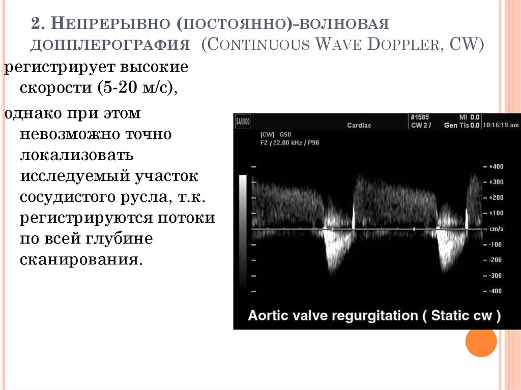 Периодически непрерывно. Импульсно-волновой допплер в УЗИ. Импульсная спектральная допплерография. Постоянно волновой допплер и импульсно-волновой допплер. В-режим + импульсно-волновая допплерография.