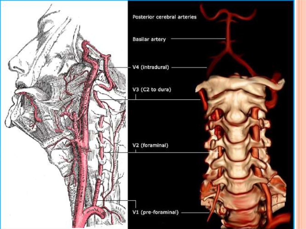 Сегмент v4 правой позвоночной артерии. Сегменты v3 v4 позвоночной артерии. Исток позвоночной артерии. Позвоночные артерии v1-v3. V3 сегмент позвоночной артерии.