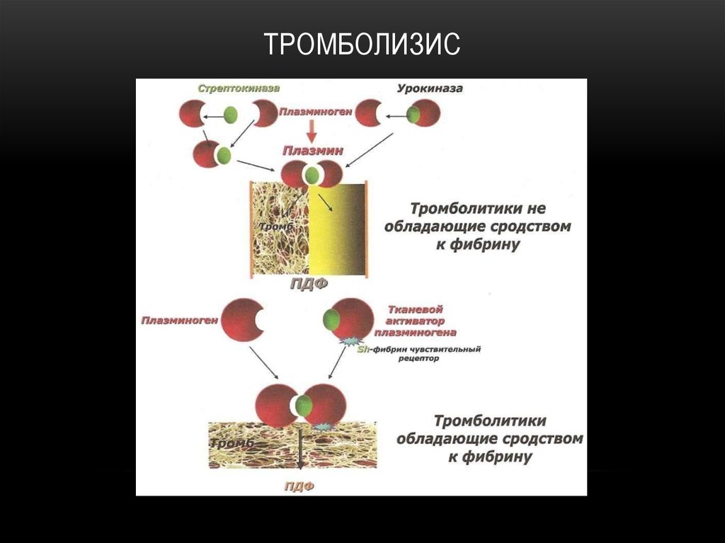 Тромболизис это. Регионарный катетерный тромболизис. Системный тромболизис. Селективный внутриартериальный тромболизис. Тромболитики схема.