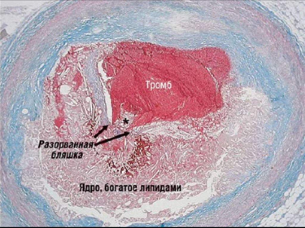 Разрыв бляшки. Атеросклеротическая бляшка. Атеросклеротическая бляшка гистология. Атеросклероз венечных артерий. Отрыв атеросклеротической бляшки.