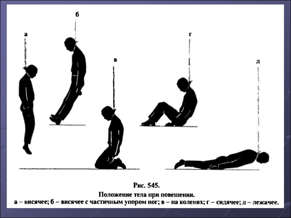 Положение тела. Положение тела при повешении. Правильная петля для повешения. Положение петли при повешении.