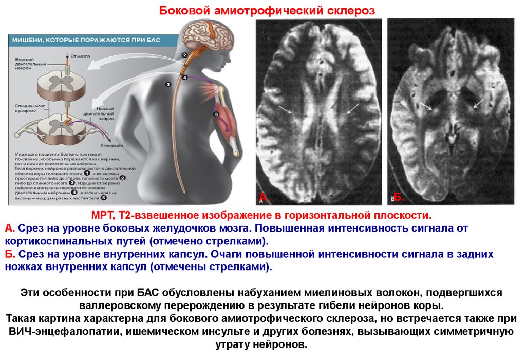 Болезнь бас что это за болезнь. Боковой амиотрофический склероз мрт. Боковой амиотрофический склероз патоморфология. Боковой амиотрофический склероз патогенез. Амиотрофический склероз на мрт.