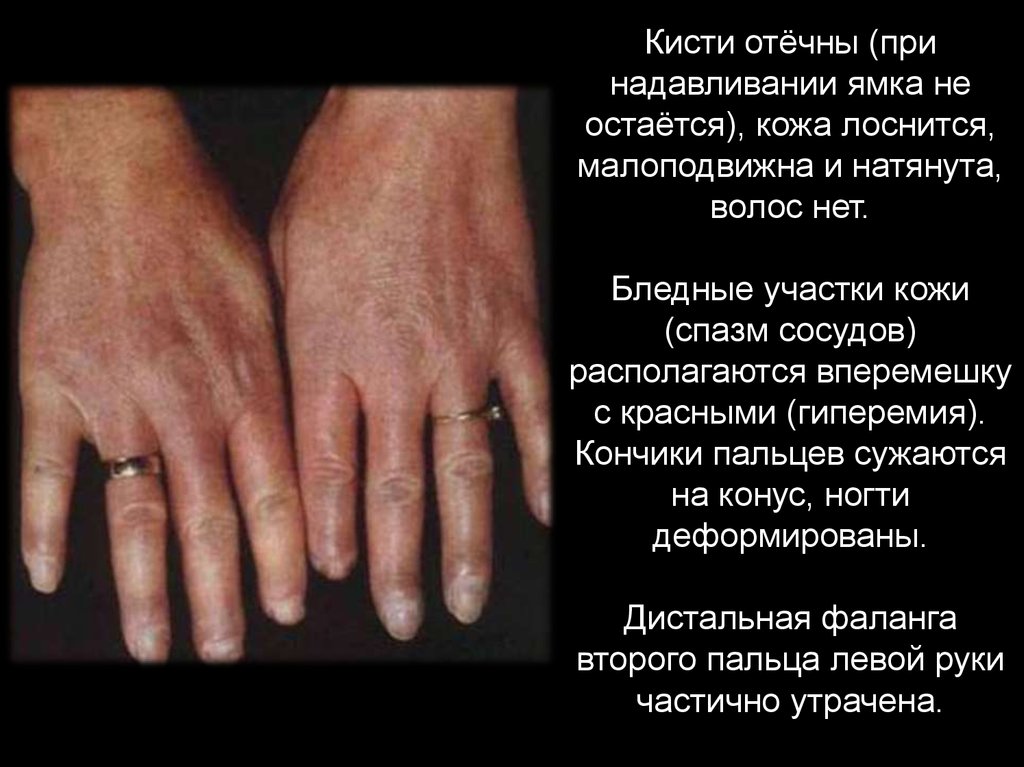 СИСТЕМНАЯ СКЛЕРОДЕРМИЯ - презентация онлайн