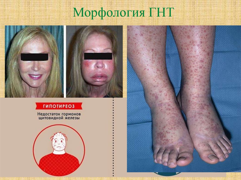 Морфология ГНТ