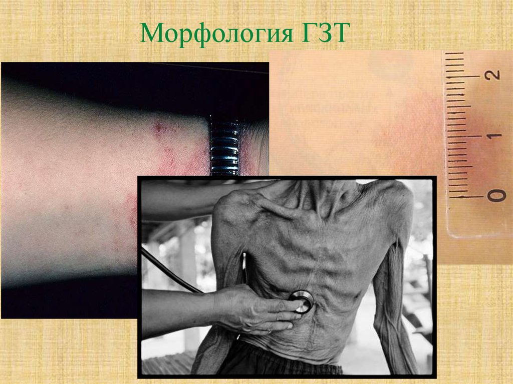 Морфология ГЗТ