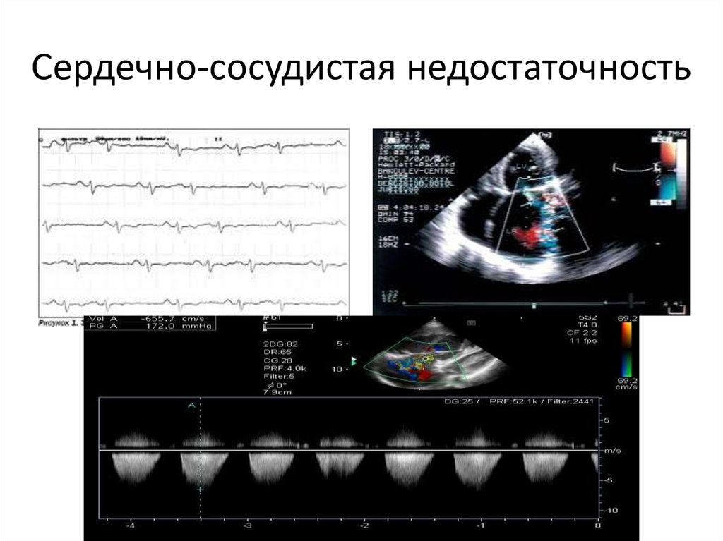 Сердечно легочная недостаточность карта вызова