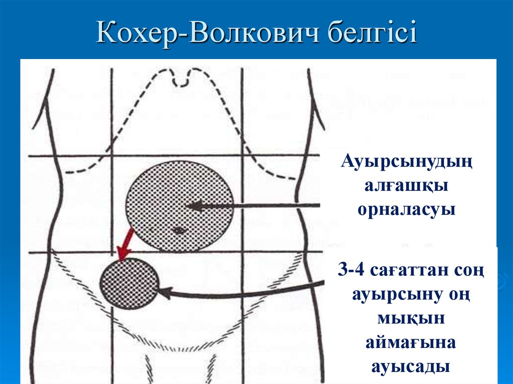 Кохер аппендицит. Кохер Волкович симптомы. Кохера Волковича при остром аппендиците. Симптом кохера-Волковича.