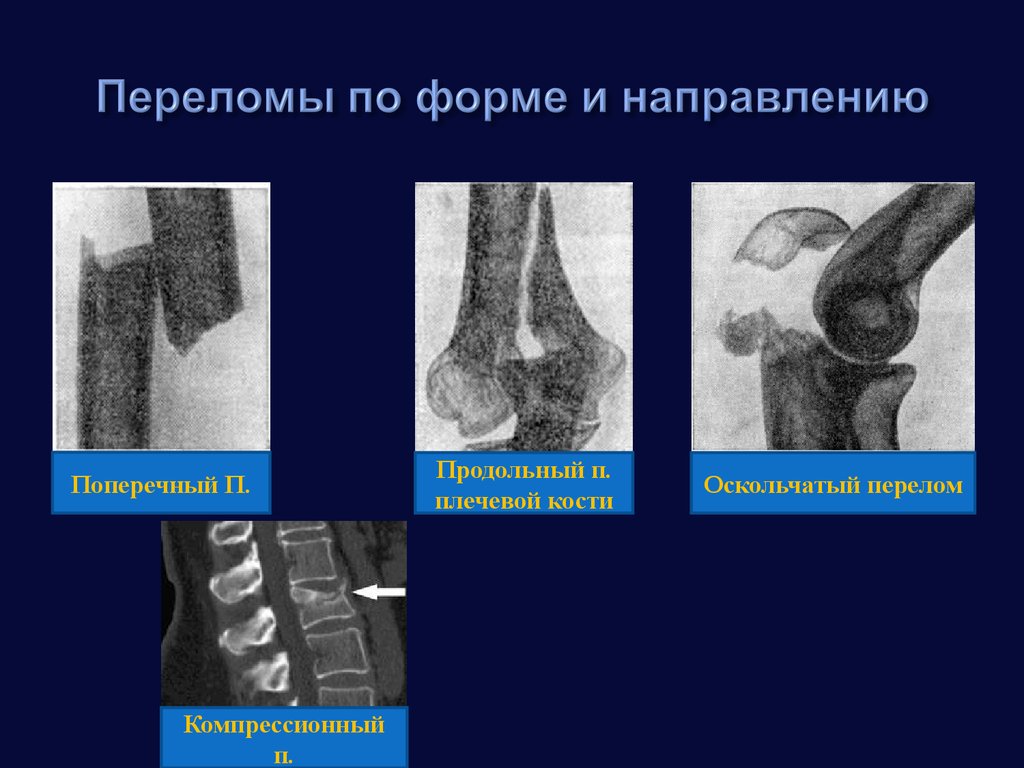 Вывихи переломы костей. Переломы по форме и направлению. Переломы по направлению. Переломы по форме и направлению перелома. Переломы по причине возникновения.