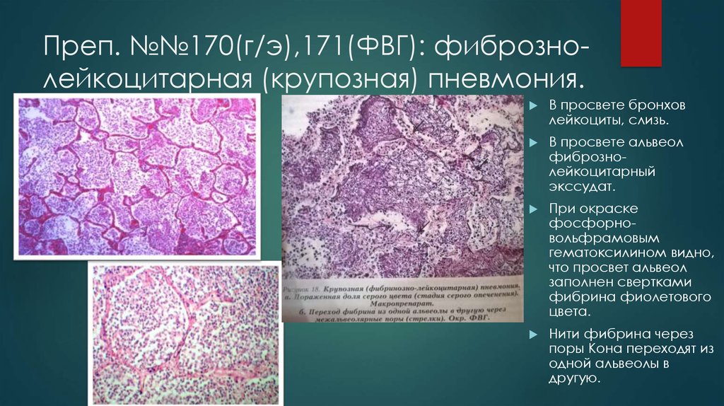 Крупозная пневмония патологическая анатомия презентация