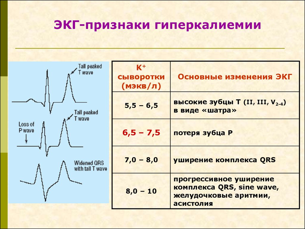 Высокий т на экг причины. Гиперкалиемия на ЭКГ. ЭКГ критерии гиперкалиемии. Признаки гиперкалиемии на ЭКГ. ЭКГ при гиперкалиемии и гипокалиемии.