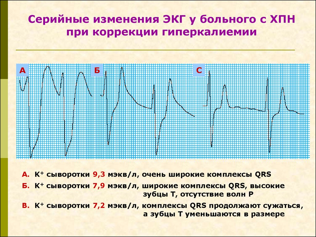 Экг при гиперкалиемии картинки