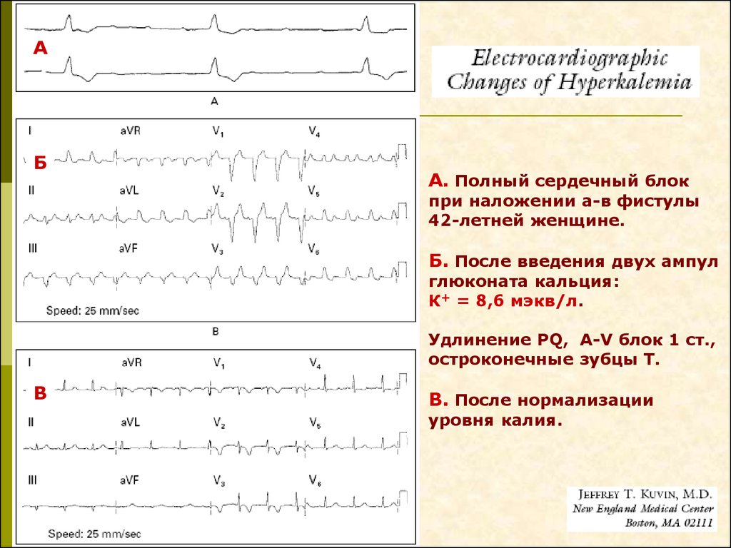 Гиперкалиемия экг картина