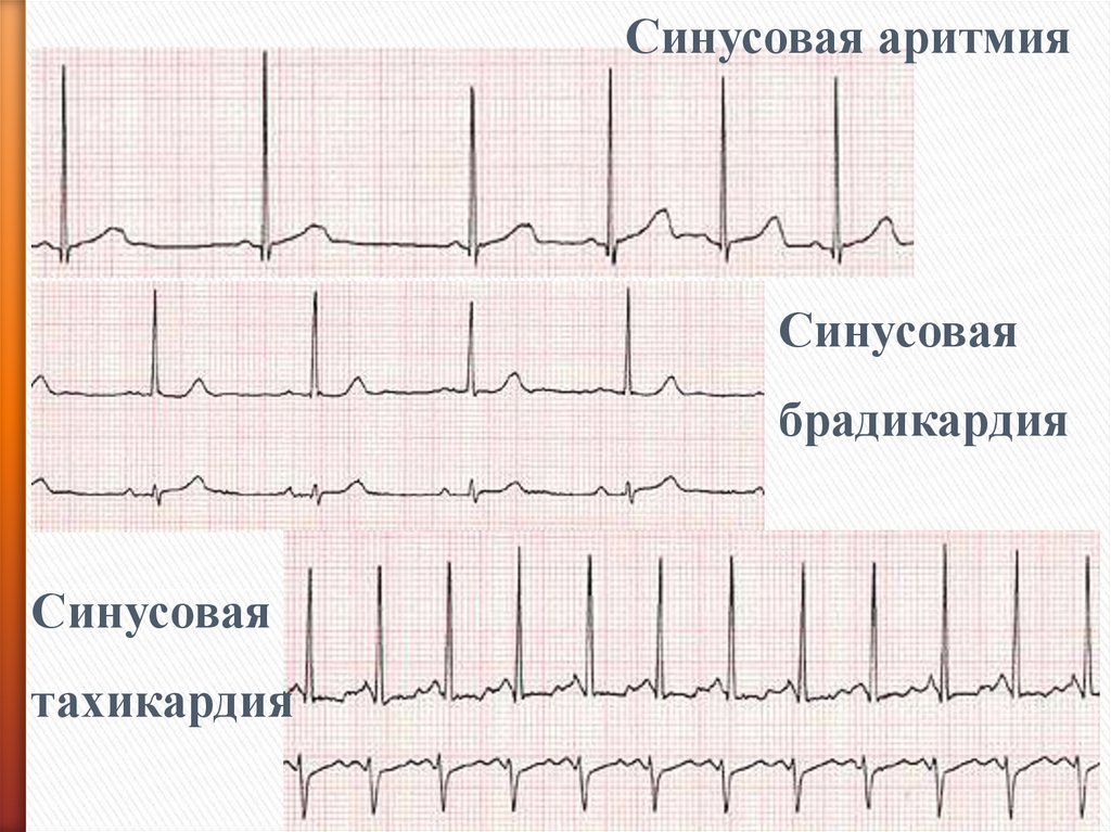 Синусовая брадикардия это. Синусовая брадикардия с синусовой аритмией. Синусовая тахикардия и брадикардия. ЭКГ синусовая тахикардия, брадикардия, аритмия. Синусовая тахикардия брадикардия аритмия.