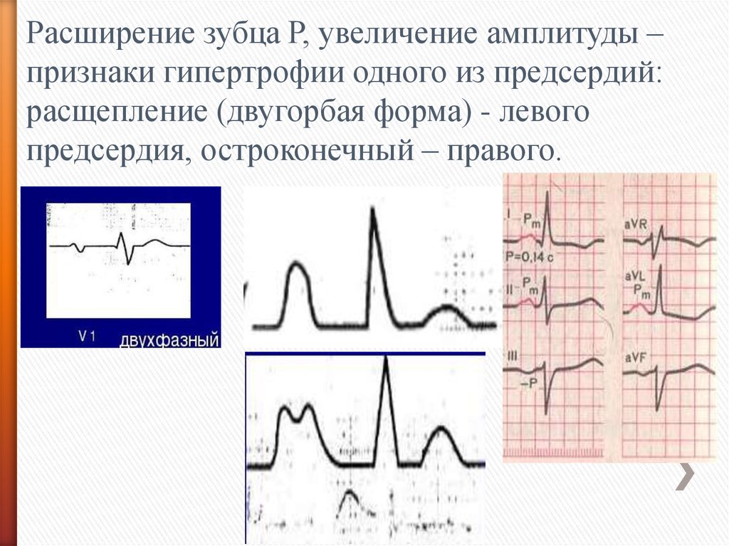 Увеличение амплитуды зубцов