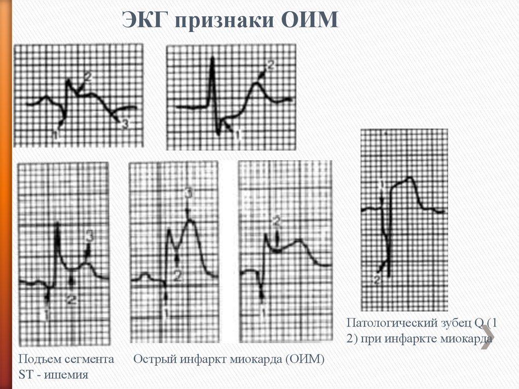 Для патологического зубца q характерно. Инфаркт миокарда ЭКГ патологический зубец q. Патологический зубец при инфаркте миокарда. Зубец QS на ЭКГ. Зубец q на ЭКГ при инфаркте.