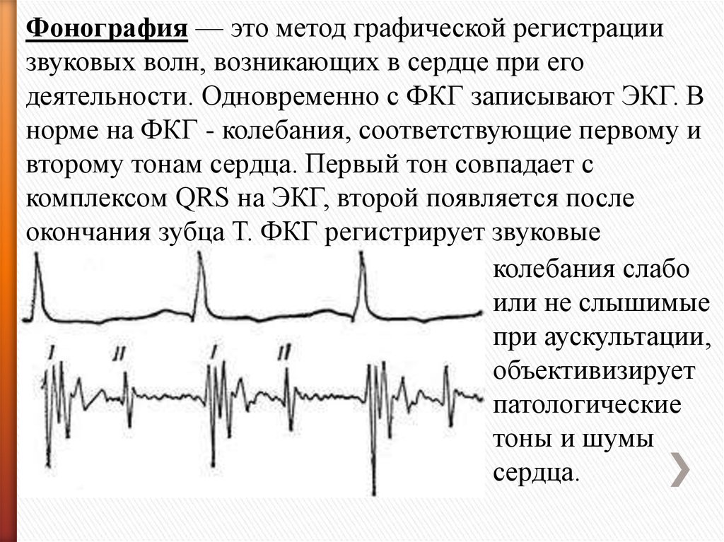 Регистрация сердца. ФКГ 1 тон. ФКГ И ЭКГ В норме.. Сопоставление ЭКГ И ФКГ. Соотношение ФКГ И ЭКГ В норме.