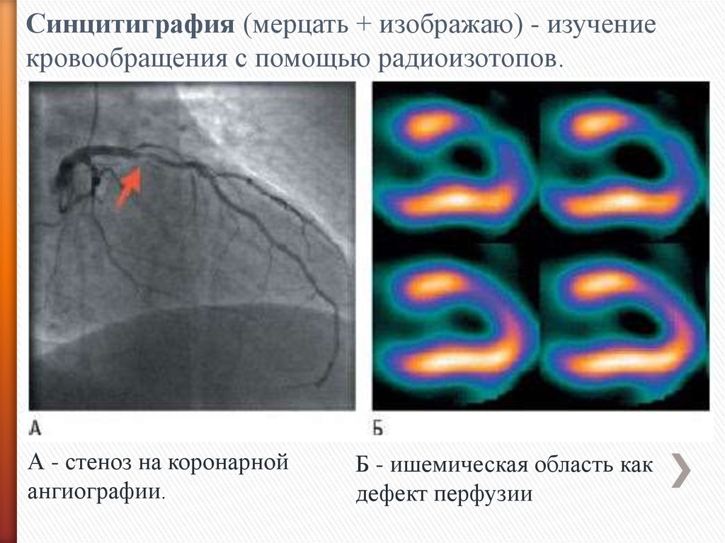 Презентация сцинтиграфия миокарда