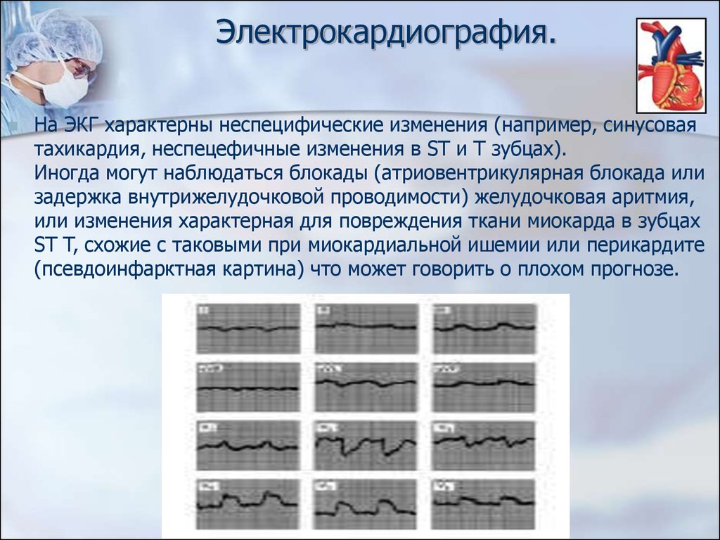 Диффузные изменения миокарда. Характерные изменения ЭКГ. Неспецифические изменения на ЭКГ. Неспецифические изменения миокарда. Неспецифические изменения миокарда на ЭКГ.