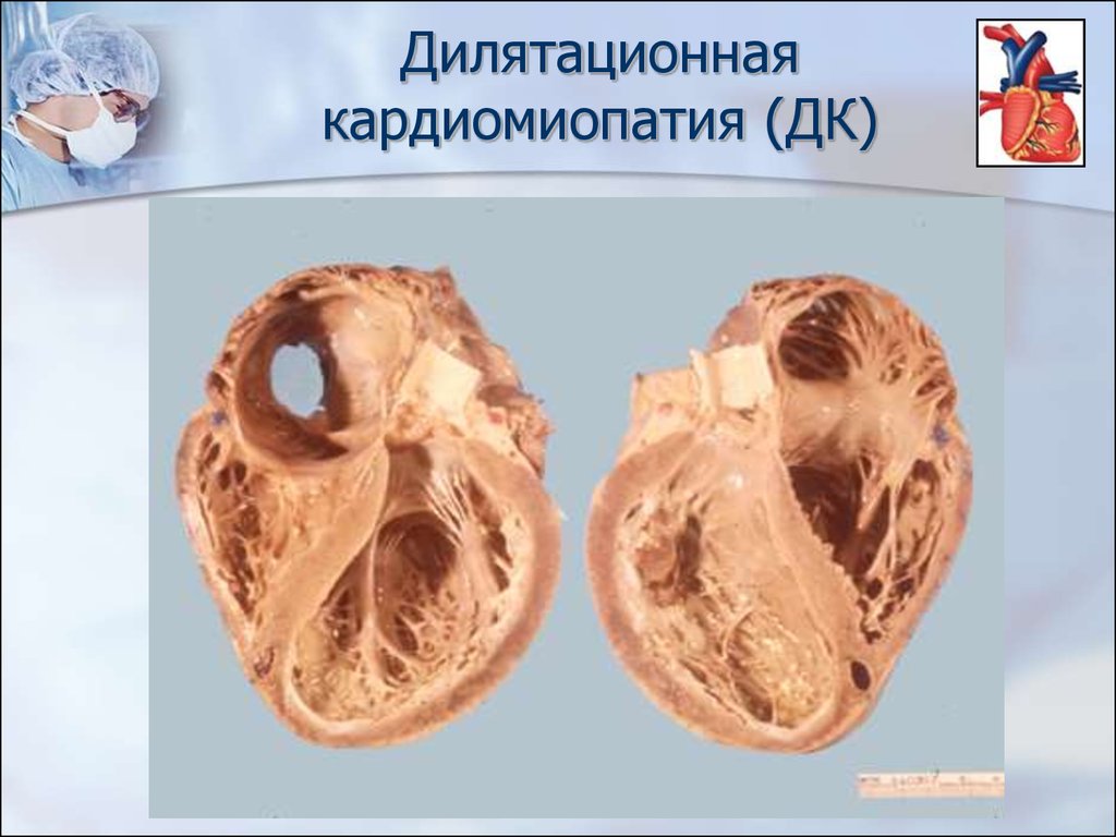 Кардиопатия сердца. Рестриктивная кардиомиопатия макропрепарат. Дилатационная гипертрофия миокарда. Гипертрофическая кардиомиопатия макропрепарат. Дилатационная кардиомиопатия сердца.