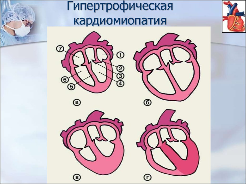 Кардиомиопатии у детей презентация