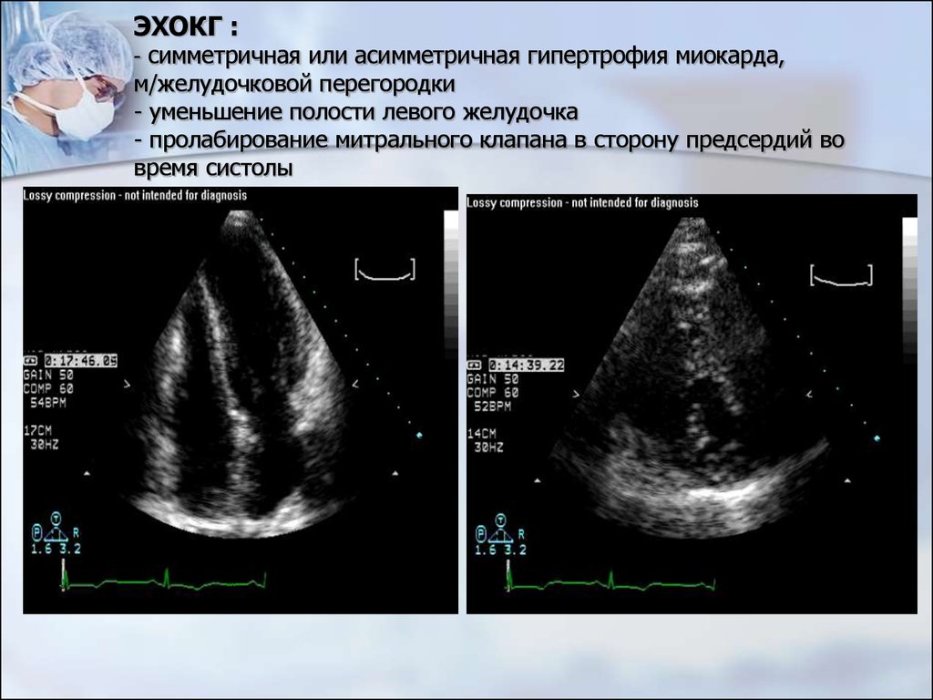 Эхо левого желудочка. Эхокардиография сердца при миокардите. Гипертрофия правого желудочка на УЗИ сердца. Эхокардиография гипертрофия правого желудочка. Эхокардиография гипертрофия левого желудочка.