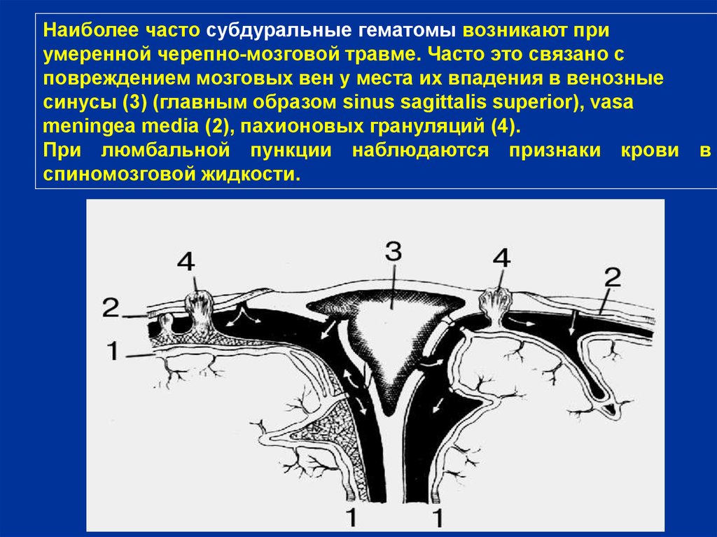 Чаще это связано с. Операции на мозговом отделе головы. Пахионовы грануляции в венозных синусах. Пахионовые грануляции. Пахионова грануляция поперечного синуса.