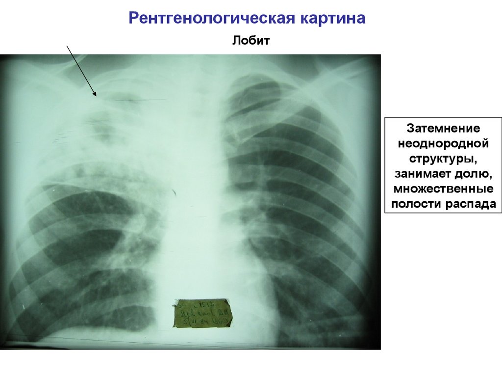Инфильтративный туберкулез верхних долей легких. Инфильтративный туберкулез рентгенография. Инфильтративный туберкулез нижней доли рентген. Инфильтративный туберкулез верхней доли рентген.