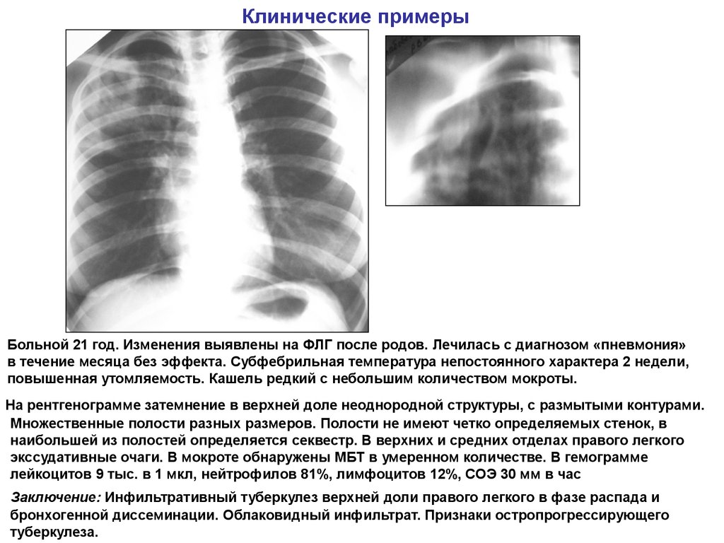 Изменения в верхней доле легкого. Очагово-инфильтративный туберкулез рентген. Инфильтративный туберкулез в фазе инфильтрации. Инфильтративный туберкулёз s1-2 левого.