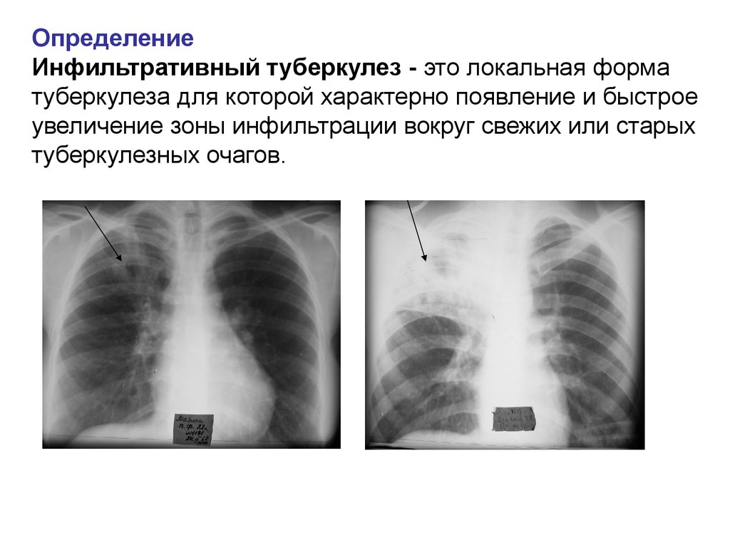 Без очаговых и инфильтративных изменений. Очагово-инфильтративный туберкулез рентген. Инфильтративная форма туберкулеза рентген. Инфильтративный туберкулёз с1 с2 с6. Очаговый туберкулез рентген.