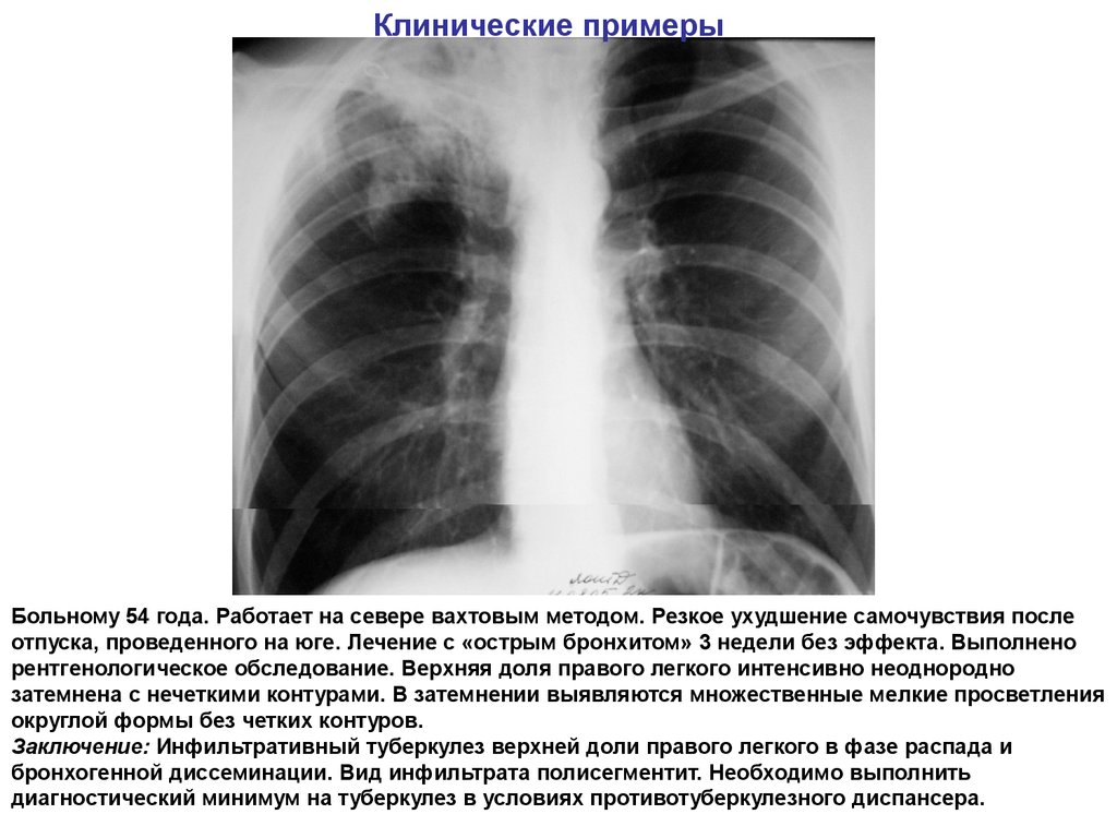 Инфильтративный туберкулез верхних долей легких. Инфильтративный туберкулез рентгенография. Очагово-инфильтративный туберкулез рентген. Инфильтративный туберкулез верхней доли рентген. Очаговый туберкулез инфильтрации.