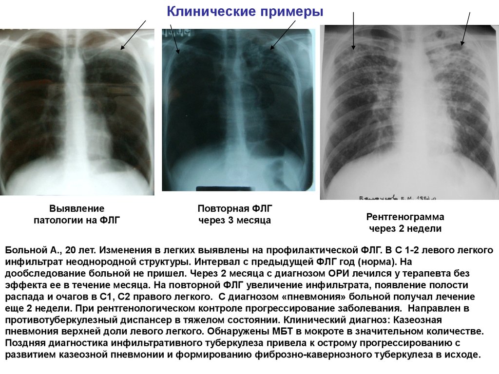 Чем отличается рентген от флюорографии. Флюорография грудной при туберкулезе. Туберкулез бронхов рентген. Флюорограмма пневмония. Пневмония на флюорографии.