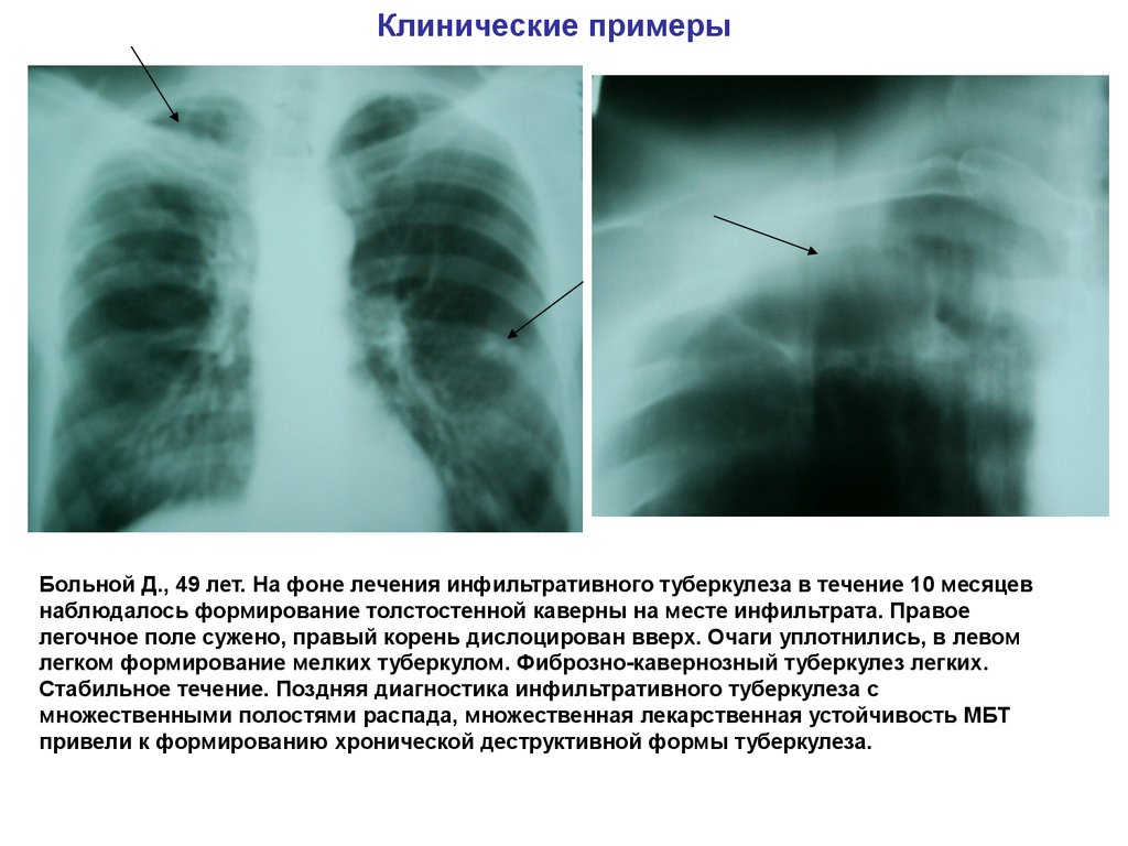 Клинический случай туберкулез