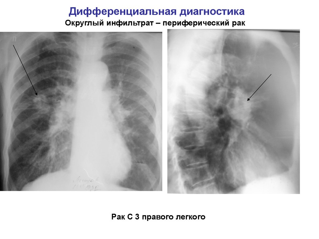 Центральный рак правого. Дифференциальная диагностика туберкулеза рентген. Дифференциальная диагностика округлого инфильтрата. Диагностикарака лёгкого. Дифференциальная диагностика инфильтративного туберкулеза.