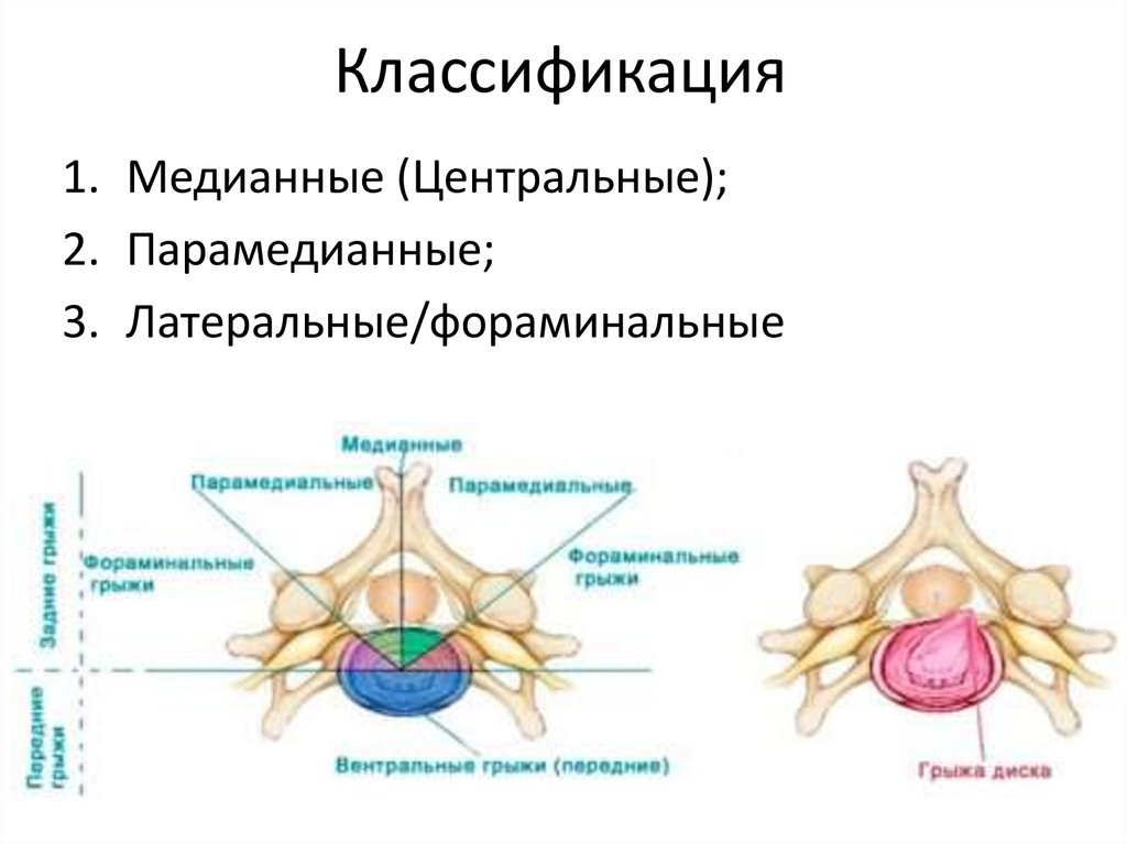 Задняя медианная грыжа