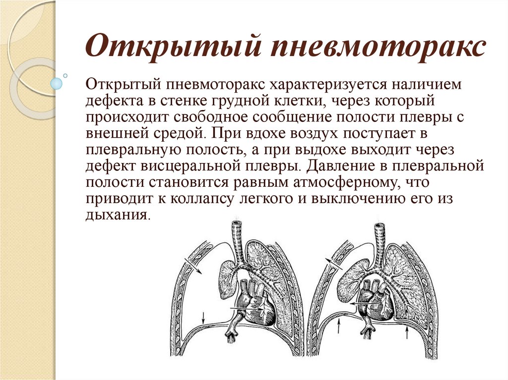 Клиническая картина открытого пневмоторакса