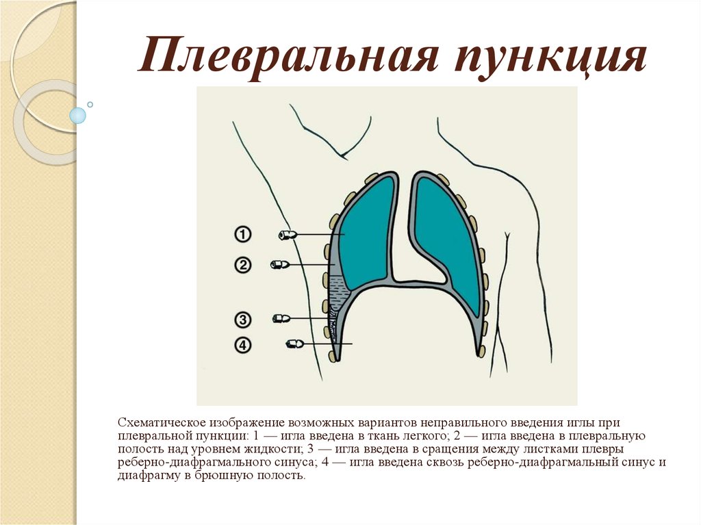 Полость провожать. Плевральная пункция место прокола. Место прокола при плевральной пункции. Место проведения плевральной пункции при гидротораксе. Пункция при эмпиеме плевры.