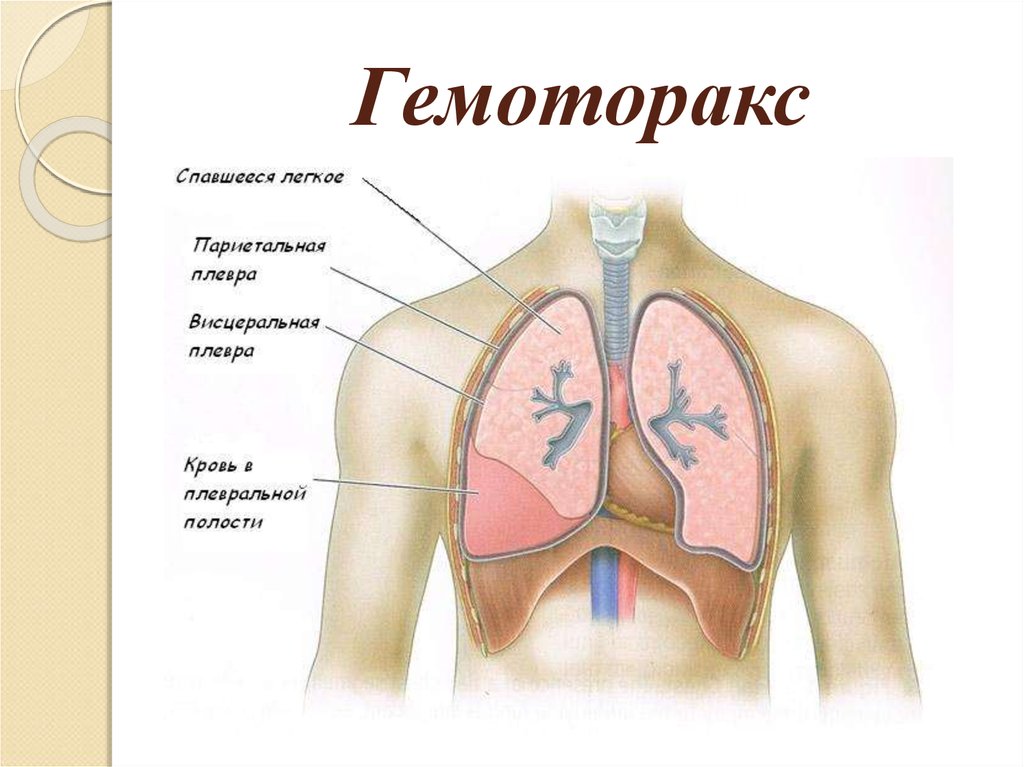 Презентация пневмоторакс и гемоторакс