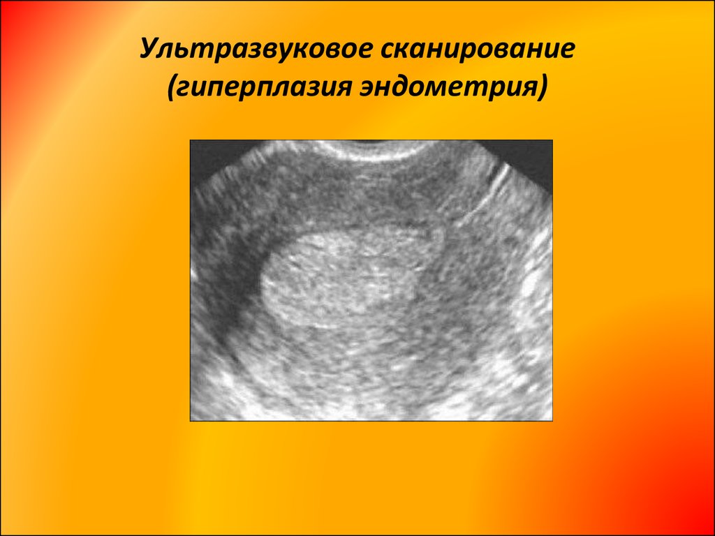 Патология эндометрия. Гиперплазия эндометрия МФЯ. Эхография гиперплазии эндометрия. Локальная гиперплазия эндометрия на УЗИ. АМК гиперплазия эндометрия.