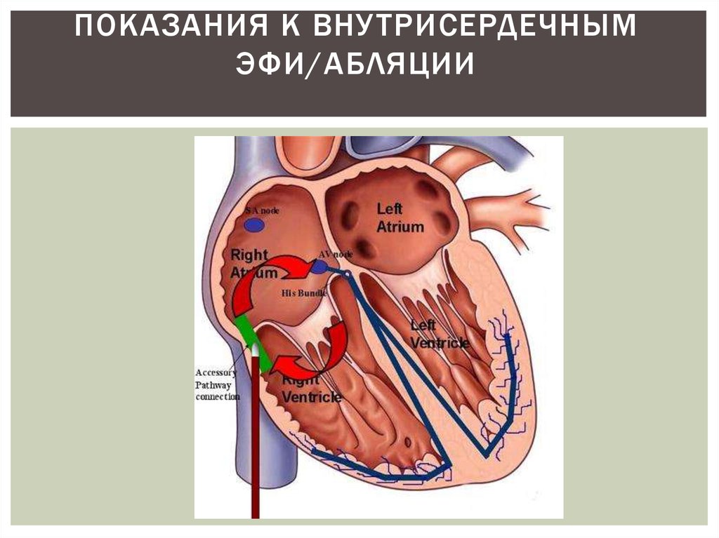 Абляция сердца при мерцательной. Электрофизиологическое исследование сердца показания. Внутрисердечная эхокардиография. Внутрисердечное электрофизиологическое исследование сердца (эфи). Эндокардиальное эфи.