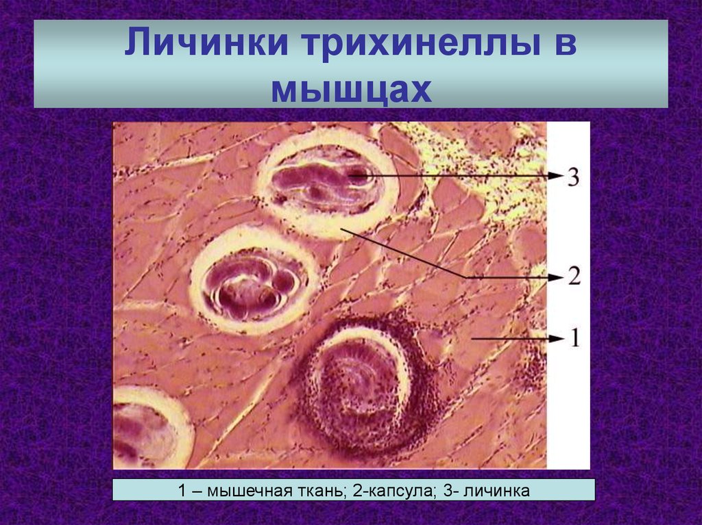 Инкапсулированные личинки трихинеллы в мышцах рисунок с обозначениями