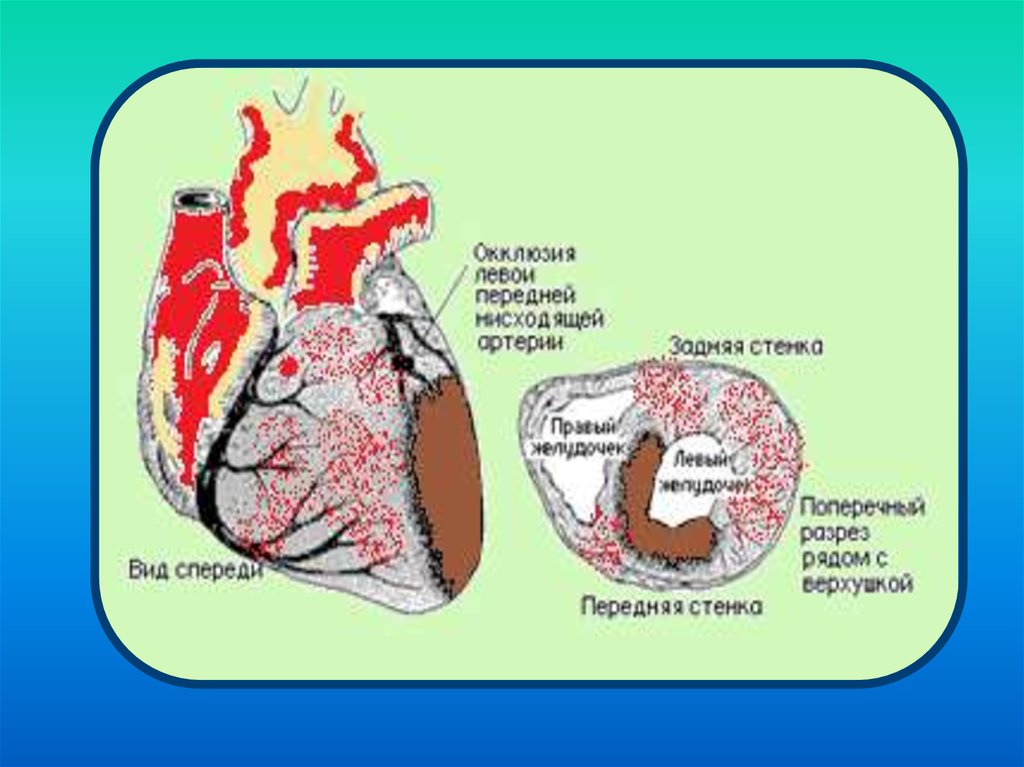 Миокардиальная сердечная недостаточность. Миокардиальная недостаточность сердца. Миокардиальная форма сердечной. Миокардиальные формы сердечной недостаточности. Миокардиальная форма сердечной недостаточности патогенез.