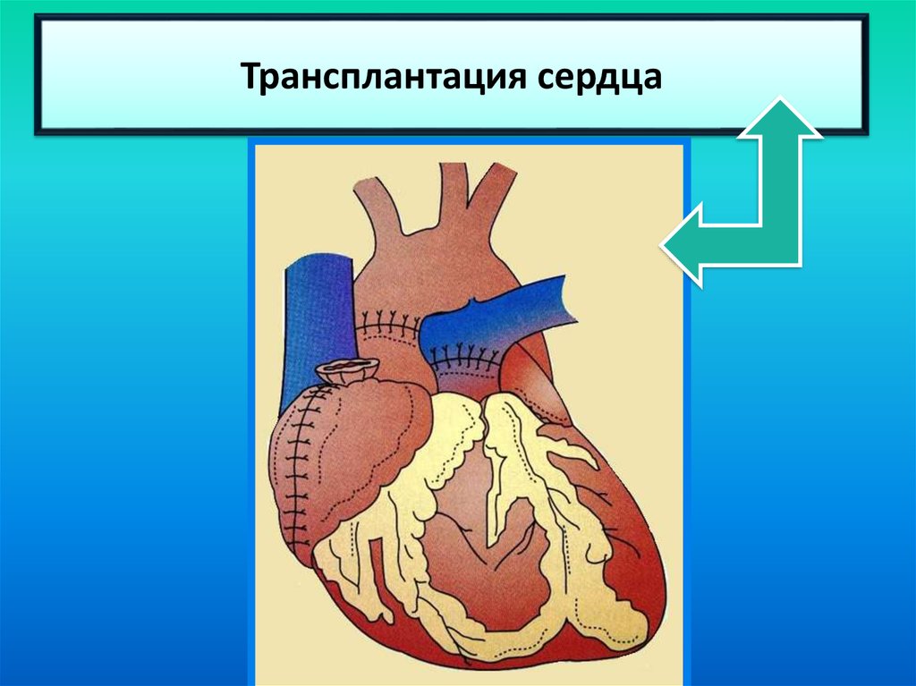 Трансплантация сердца презентация