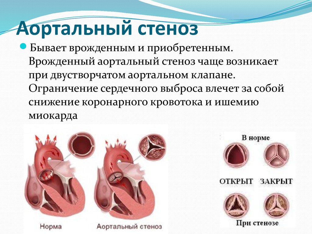 Причины стеноза аортального клапана. Порок аортального клапана. Порок сердца стеноз аортального клапана. ВПС двустворчатый аортальный клапан. Двухстворчатый клапан аорты стеноз.