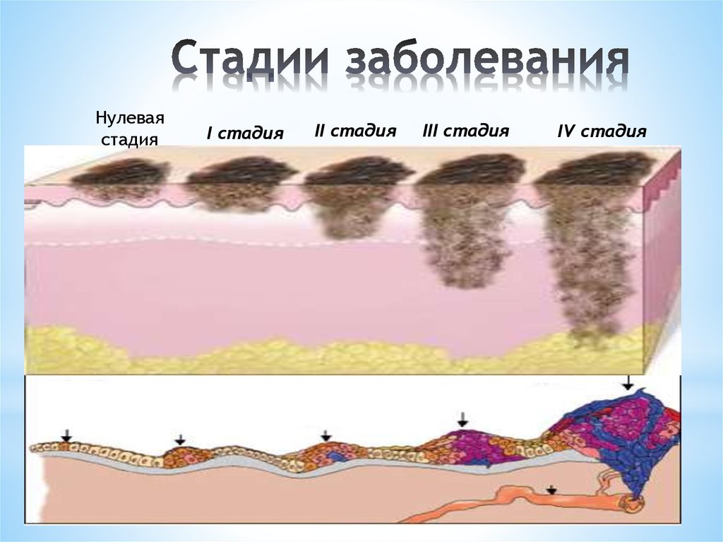 Стадии кожи. Меланома факторы риска. Факторы риска меланомы кожи.