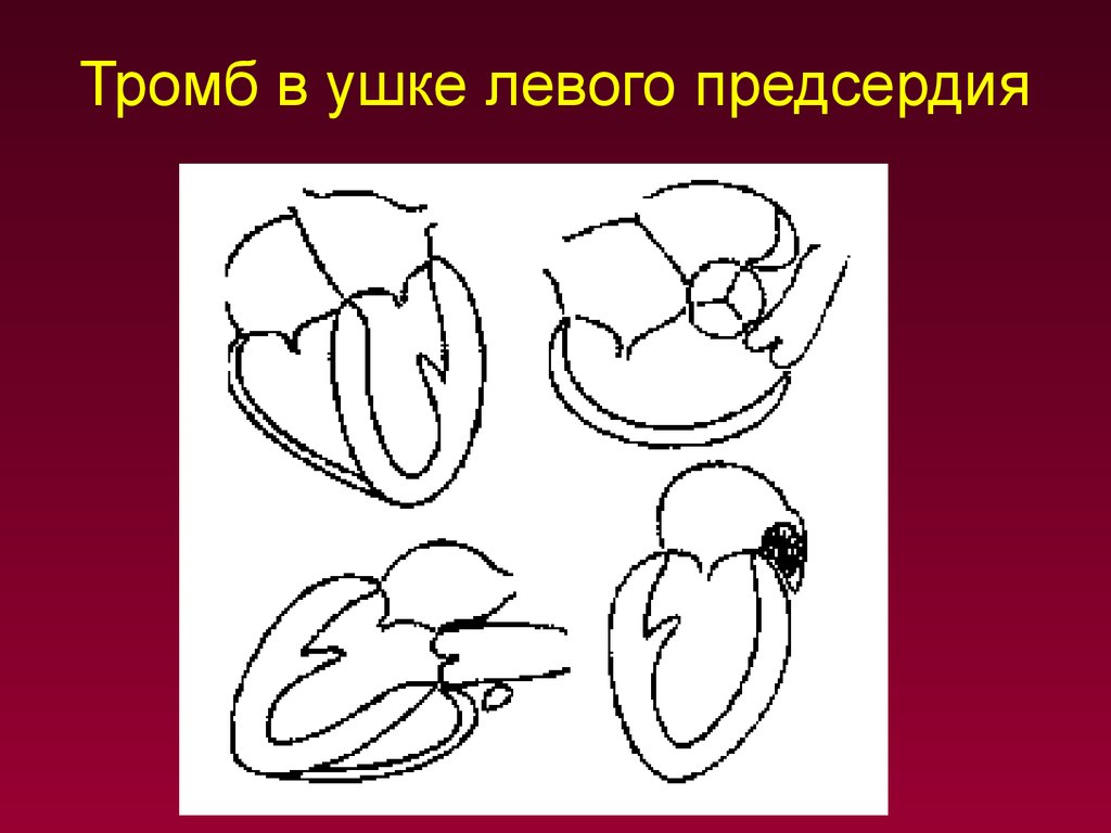 Ухо сердца. Тромб в ушке левого предсердия. Тромбоз ушка левого предсердия.