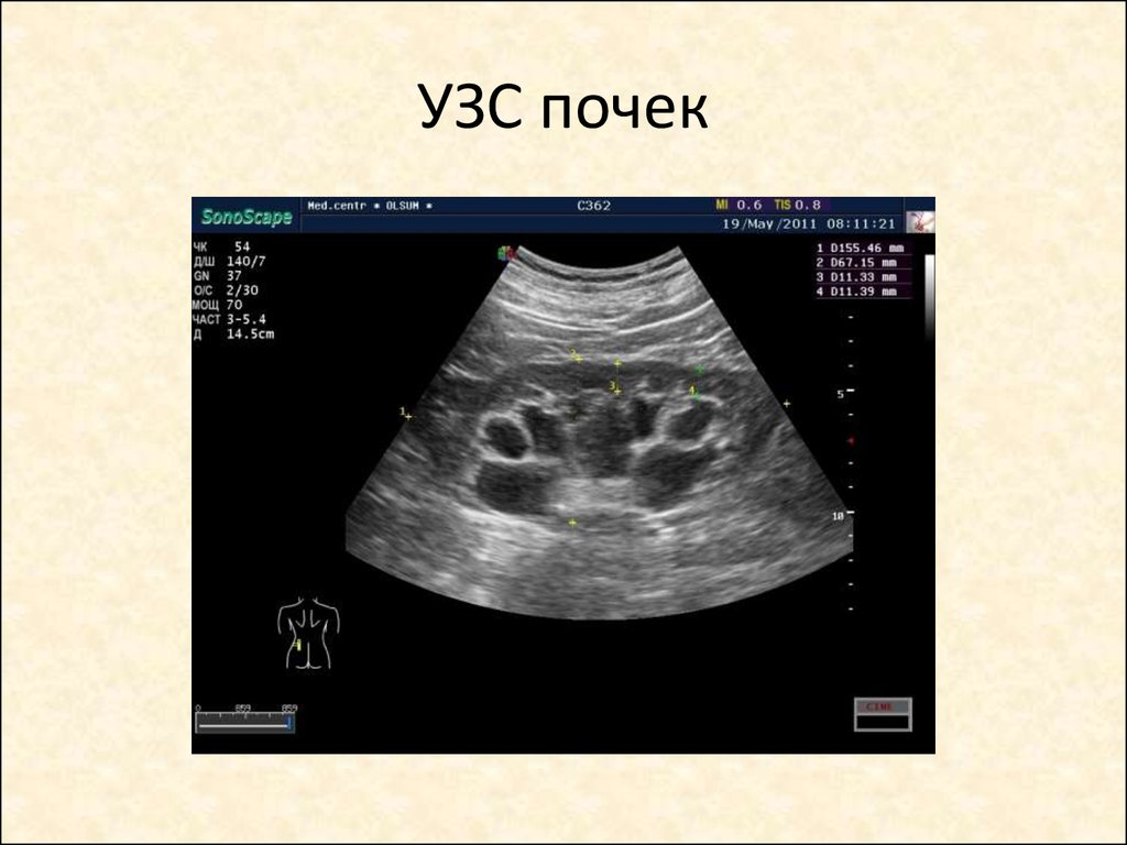 Взрослый почка узи. Диабетическая нефропатия УЗИ почек. Дисметаболическая нефропатия на УЗИ. Диабетическая нефропатия УЗИ признаки.