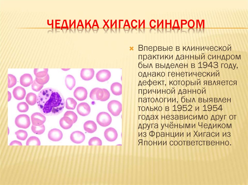 Чедиака Хигаси синдром