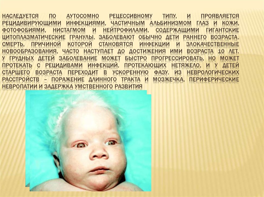 Наследуется по аутосомно рецессивному типу, и проявляется рецидивирующими инфекциями, частичным альбинизмом глаз и кожи, фотофобиями, нис